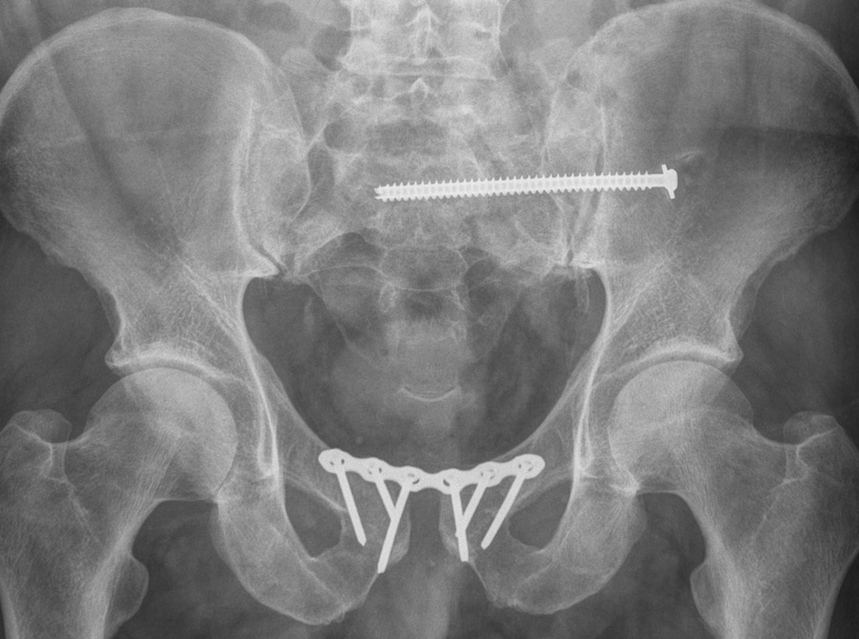 Pelvis Pubic Symphysis Plate 1